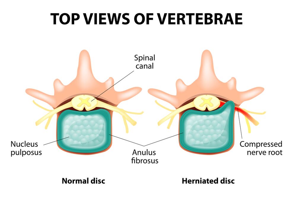 Disiki meterverteblol ati hernia