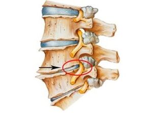 Awọn ami ati awọn aami aiṣan ti osteochondrosis