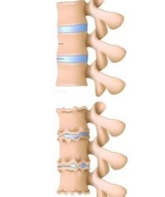 Awọn okunfa ti osteochondrosis