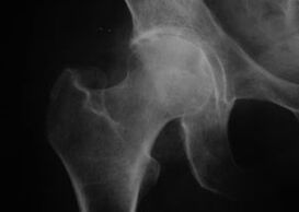 X-ray ti apapọ apapọ pẹlu arthrosis