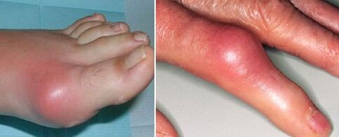 ifarahan awọn isẹpo pẹlu arthritis