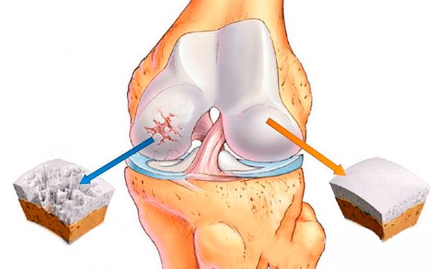 Apapọ orokun deede (ọtun) ati ọkan ti o kan nipasẹ arthrosis (osi)