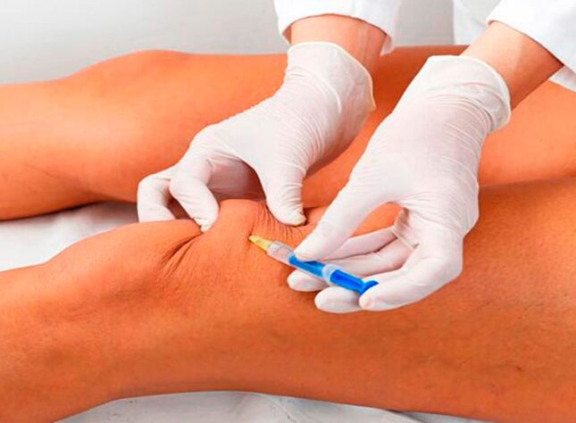 Awọn abẹrẹ inu-articular ti awọn oogun fun arthrosis ti isẹpo orokun