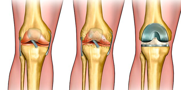 Ni ipele kẹta ti arthrosis, rirọpo orokun nilo