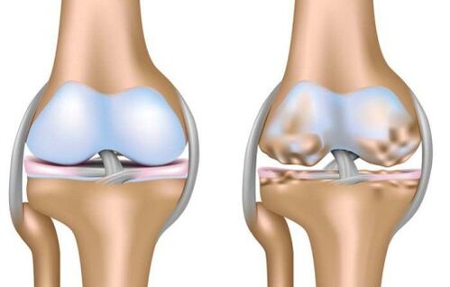 isẹpo ilera ati iparun ti isẹpo orokun ni arthrosis