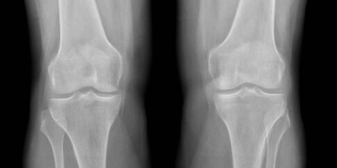 orokun osteoarthritis x-ray