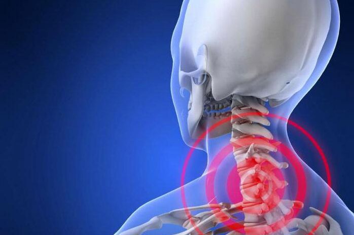 Irora ibon ni ọrun - ami aisan kutukutu ti osteochondrosis cervical