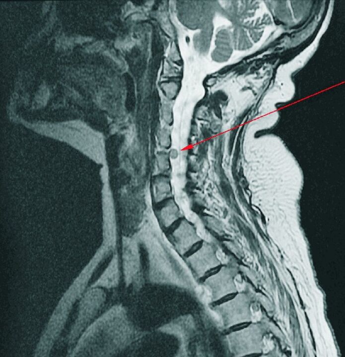 Awọn hernia intervertebral ti ọpa ẹhin ara lori MRI