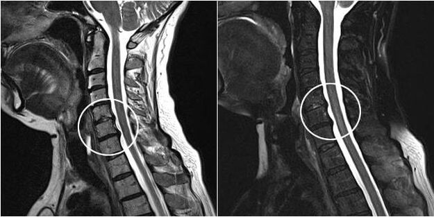 MRI ti ọpa ẹhin ara pẹlu awọn ami ti osteochondrosis