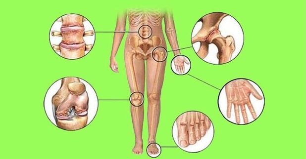 awọn isẹpo ti o ni ipa nipasẹ arthritis ati arthrosis