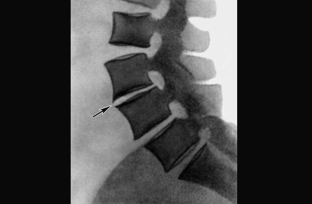 Awọn ifihan ti osteochondrosis ti ọpa ẹhin thoracic lori redio