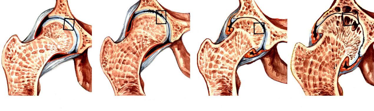 Awọn iwọn ti deforming coxarthrosis