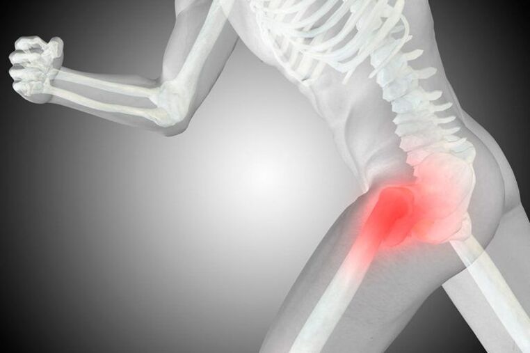 Coxarthrosis ti isẹpo ibadi