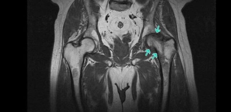 Degenerative-dystrophic ayipada ninu awọn ibadi isẹpo on MRI