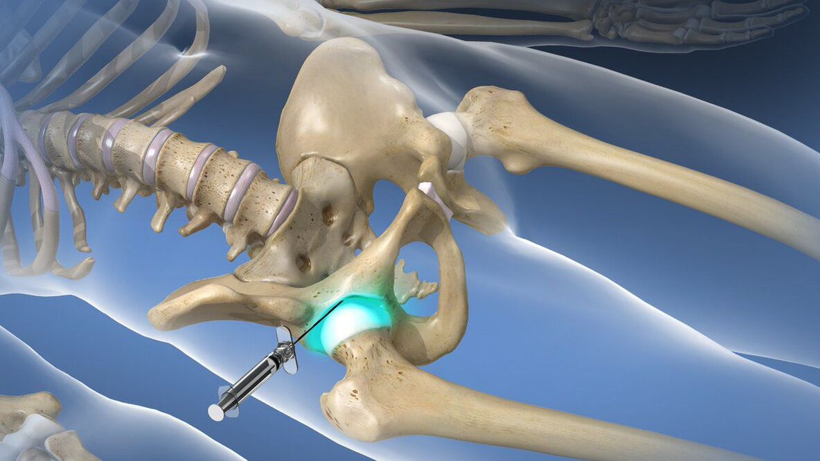 Intra-articular blockade lati se imukuro ńlá irora ni coxarthrosis