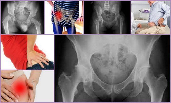 Irora ati arinbo lopin jẹ awọn aami aiṣan akọkọ ti osteoarthritis ibadi