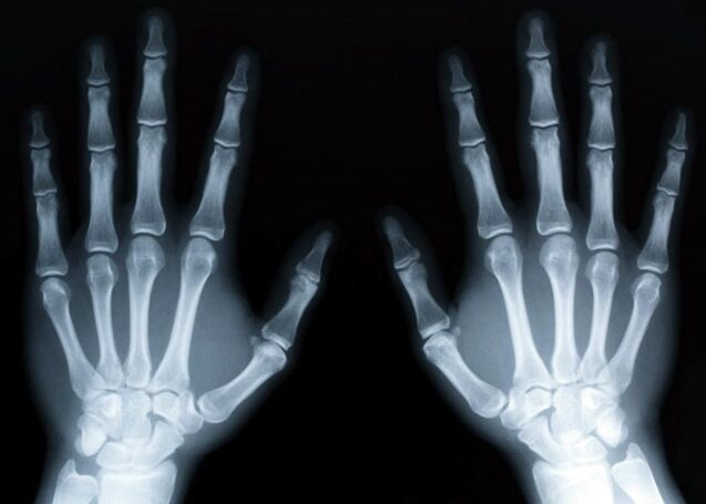 Gout nfa idagbasoke ti arthritis gouty, eyiti o le ṣe ayẹwo ni lilo awọn egungun x-ray