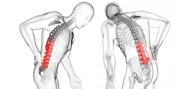 ilolu pẹlu osteochondrosis cervical